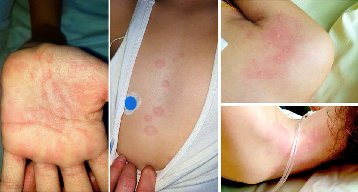 Maculopapular rash in a 12-year-old girl