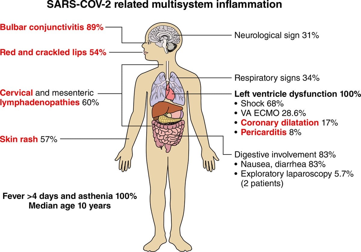 sars-cov-2 related multisystem inflammation